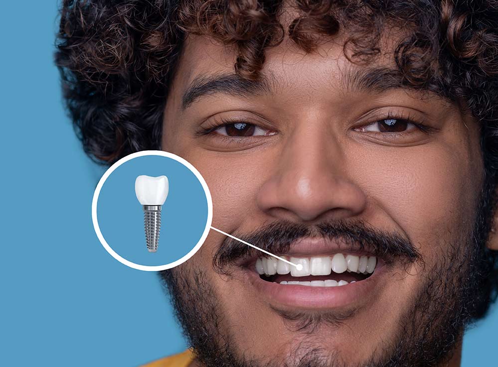 Dental-Implants