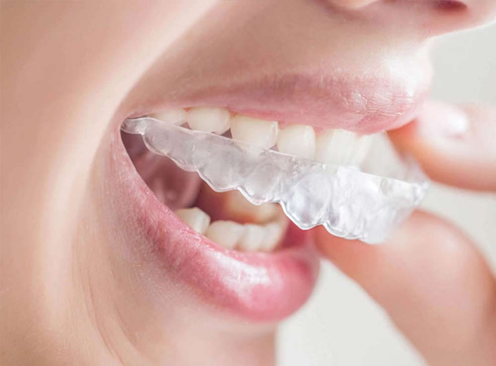 Invisible-Aligners